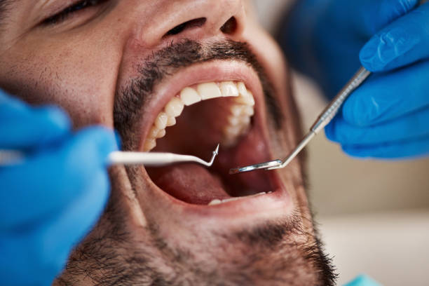 Best Emergency Wisdom Teeth Removal in Hampton, IA
