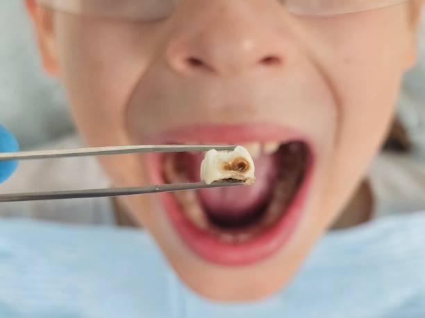 Best Emergency Tooth Extraction in Hampton, IA
